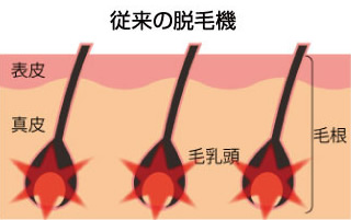 従来の脱毛機